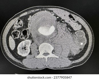 CT scan abdominal aortic aneurysm