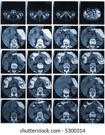 CT Scan Of Abdominal Area