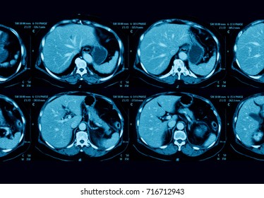 CT Scan Of Abdominal Pain