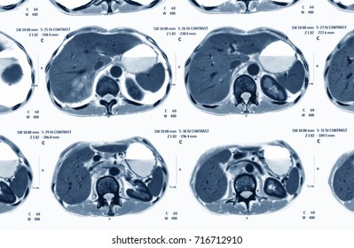 CT Scan Of Abdominal Pain, Case Of Cholangiocarcinoma (CCA)