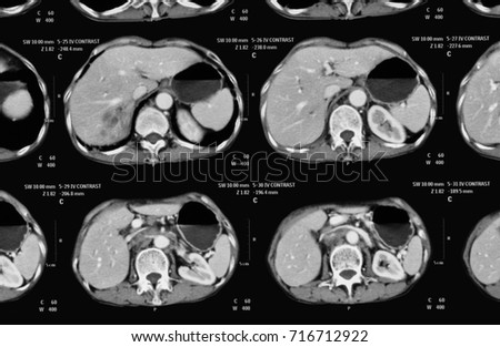 CT scan of abdominal pain, case of Cholangiocarcinoma
,
