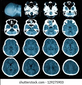 CT Scan Of Brain