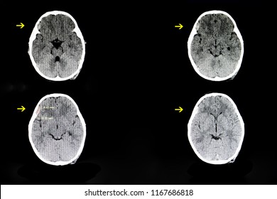 CT Scan Of A Brain Of A 4 Year Old Child With A History Of Crush Injury (hit By A Falling TV) Showing A Small Subdural Hematoma In His Right Frontotemporal Cerebral Area.