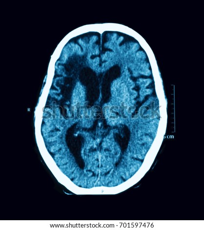 CT scan of the brain, case of old CVA (Cerebrovascular Accident), Atrial Fibrillation (AF) and Dilated cardiomyopathy (DCM)