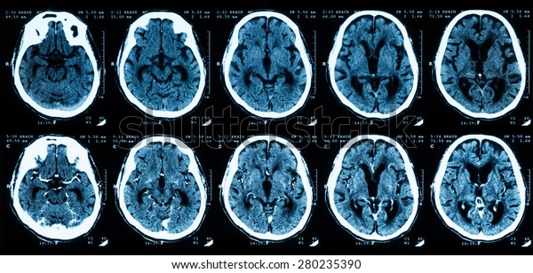 ct scan brain without contrast