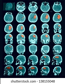 CT Scan Of The Brain. Hemorrhagic Stroke. Red Us To Identify The Lesion Focus. Documentary Photography. Information For Professionals.