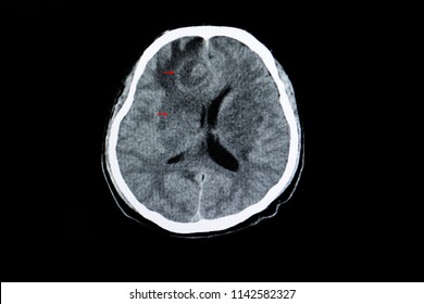 CT Scan Of A Brain Of An HIV Patient With Cerebral Toxoplasma Infection Showing Brain Edema And Ring Enhancing Lesion.
