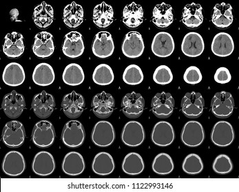 67 Anterior Cerebral Artery Images, Stock Photos & Vectors | Shutterstock