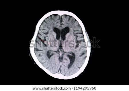 A CT scan of the brain of a patient with cerebral infarction showing a small area of lacuna infarction.  Hypertensive complication. Stroke. Weakness and hemiplegia or hemiparesis.