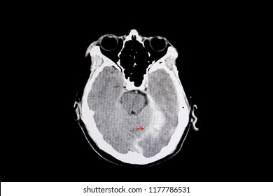 CT scan of a brain of a patient with intracerebral hemorrhage from traumatic brain injury (TBI). 