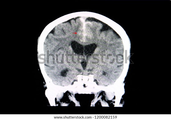 A CT\
scan of the brain of a patient with intracerebral interhemispheric\
hemorrhage from car accident. \
