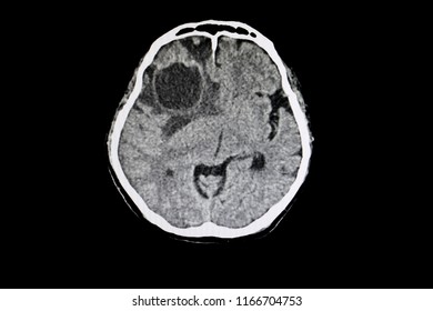 CT Scan Of A Brain Of A Patient With A Large Metastatic Cerebral Tumor With Severe Brain Edema. 