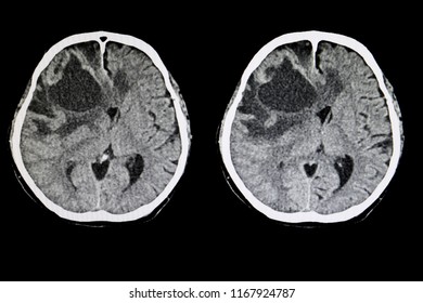 CT Scan Of A Brain Of A Patient With A Large Metastatic Tumor With Cerebral Edema.