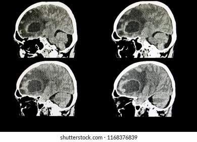 CT Scan Of A Brain Of A Patient With A Large Metastatic Tumor 