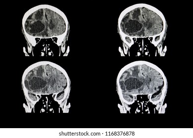 CT Scan Of A Brain Of A Patient With A Large Metastatic Tumor 