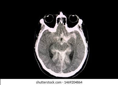A CT scan of the brain of a patient with traffic accident showing acute subarachnoid hemorrhage.