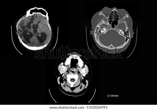 Ct Scan Brain Show Hydrocephalus Stock Photo 1310026993 | Shutterstock