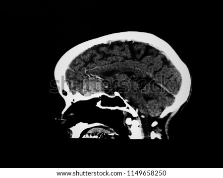 ct scan of brain, showed brain tumor