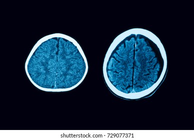 Ct Scan Of The Brain, Showing Child Brain (a 1 Year Old Boy)(left) And Brain Atrophy ( A 90 Year Old Male)