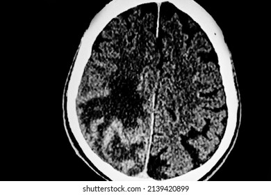 Ct Scan Of Brain Showing A Right Tumor In The Right Cerebral Hemisphere. Medical Themes