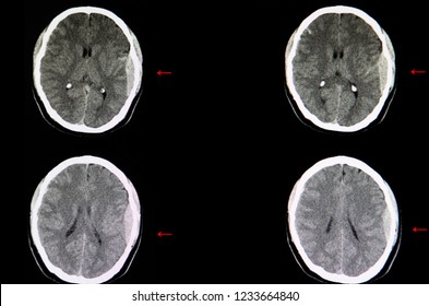 CT Scan Of The Brain Of A Traffic Accident Patient Showing Large Epidural Hemorrhage On His Left Cerebral Hemisphere With Some Degree Of Brain Edema. Medical Education.