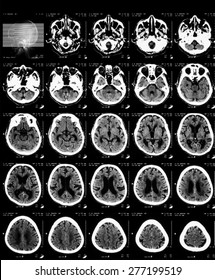 CT Scan Of Brain Without Contrast Media.