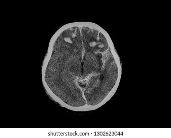 CT scan of brain,showed interhemispheric subdural hemorrhage and subarachnoid hemorrhage