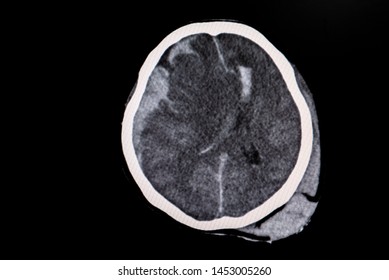 CT scan of brain,showed interhemispheric subdural hemorrhage and subarachnoid hemorrhage.