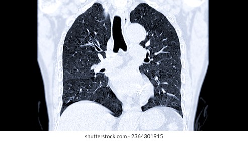 CT scan of Chest coronal view for diagnostic Pulmonary embolism (PE) , lung cancer and covid-19. 