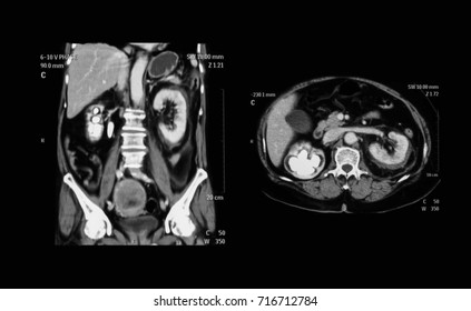 CT Scan (computed Tomography) Of Abdominal (urinary Tract), Showing Right Kidney Stone