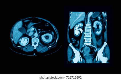 CT Scan (computed Tomography) Of Abdominal (urinary Tract), Showing Right Kidney Stone