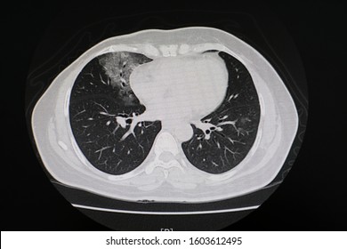 CT Scan (computed Tomography) Of Chest Organs.