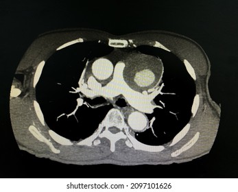 CT Scan (computed Tomography) Of Chest And Abdominal Organs In Patient Who Has Aortic Dissection At Descending Aorta.