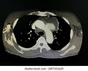 CT Scan (computed Tomography) Of Chest And Abdominal Organs In Patient Who Has Aortic Dissection At Descending Aorta.