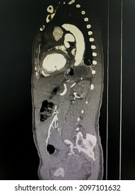 CT Scan (computed Tomography) Of Chest And Abdominal Organs In Patient Who Has Aortic Dissection At Descending Aorta.