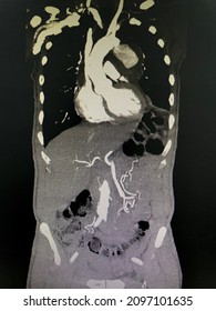 CT Scan (computed Tomography) Of Chest And Abdominal Organs In Patient Who Has Aortic Dissection At Descending Aorta.