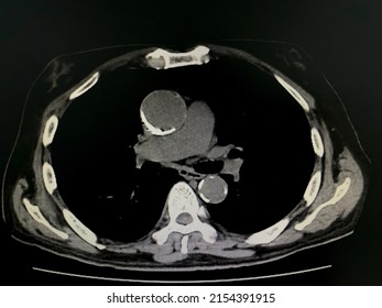 CT Scan (Computed Tomography) Of Chest Organs And Calcified At Ascending Aorta