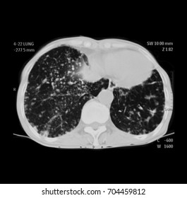 CT Scan (computed Tomography) Of Chest, Coronal View, Showing Pulmonary Metastasis, Lung Cancer