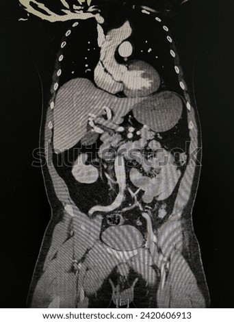 CT scan (computed tomography) of chest and abdominal organs in patient who has aortic dissection at ascending aorta.