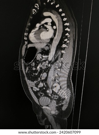 CT scan (computed tomography) of chest and abdominal organs in patient who has aortic dissection at descending aorta.