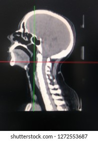 Ct Scan Head Neck Shows Clearly Stock Photo 1272553687 | Shutterstock