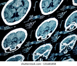 CT Scan Of Human Head, Portion Of Slide.