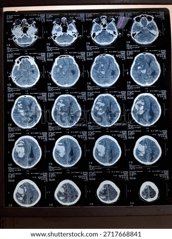 A CT scan image of the brain 🧠! It's a grayscale cross-sectional view showing the brain's structure - gray matter, white matter, ventricles, and skull
Jawa Timur Indonesia 
Wednesday, 24 Des 2025