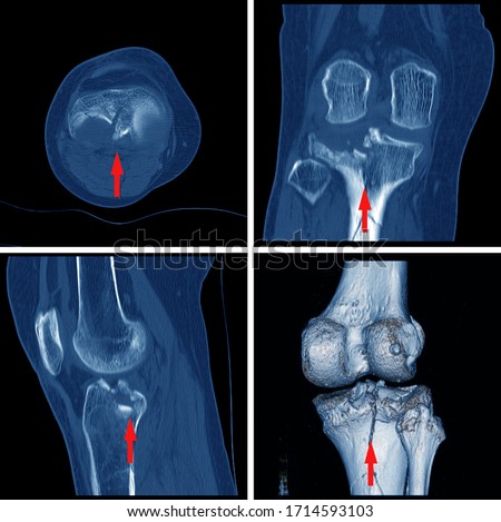 CT scan knee Fracture of intercondylar eminence of tibia. Compression fracture of posterior of lateral tibial plateau which involved articular surface.Medical image concept.