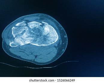 CT Scan Knee Of The Patient Periarticular Injuries Fracture Of The Proximal Tibia Frequently Associated With Soft Tissue Injuries.Medical Concept.