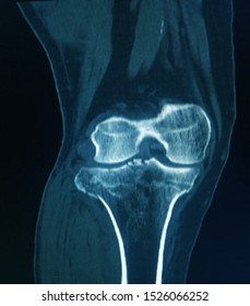 CT Scan Knee Of The Patient Periarticular Injuries Fracture Of The Proximal Tibia Frequently Associated With Soft Tissue Injuries.Medical Concept.