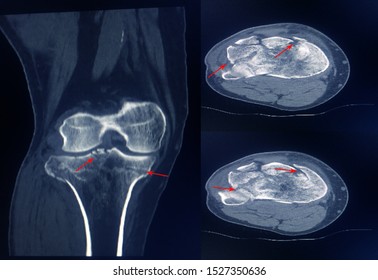 CT Scan Knee Of The Patient Periarticular Injuries Fracture Of The Proximal Tibia Frequently Associated With Soft Tissue Injuries.Medical Concept.