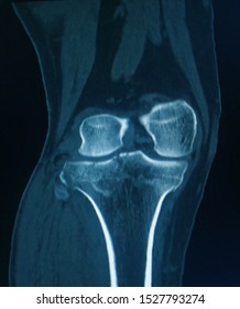 CT Scan Knee Of The Patient Periarticular Injuries Fracture Of The Proximal Tibia Frequently Associated With Soft Tissue Injuries.Medical Concept.