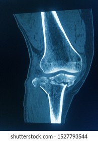 CT Scan Knee Of The Patient Periarticular Injuries Fracture Of The Proximal Tibia Frequently Associated With Soft Tissue Injuries.Medical Concept.