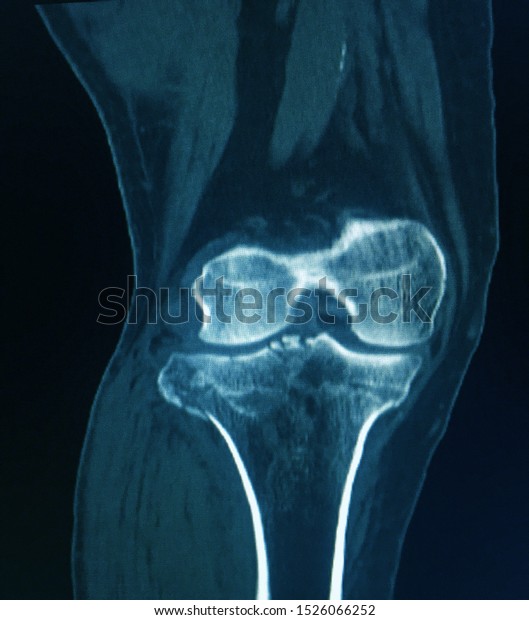 Ct Scan Knee Patient Periarticular Injuries Stock Photo 1526066252 ...